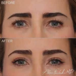 blepharoplasty-upper-eyelid-18-full-brow-lift-f