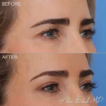 blepharoplasty-upper-eyelid-18-full-brow-lift-ro