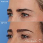 brow-lift-3-blepharoplasty-upper-eyelid-lo